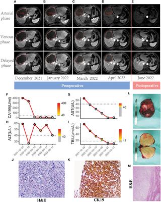 Case report: A report of the complete pathological response of intrahepatic cholangiocarcinoma after conversion therapy